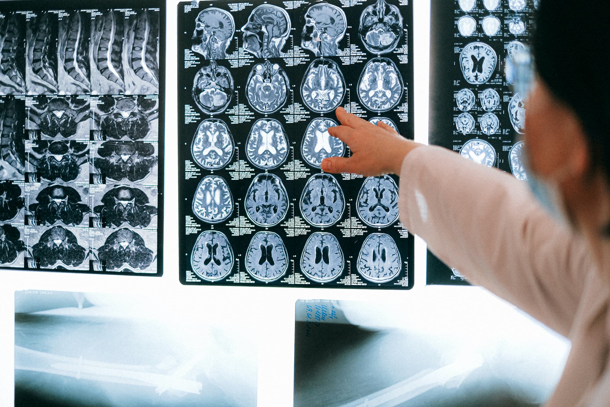 doctor pointing to a wall of brain and spinal cord scans showing neurology imaging