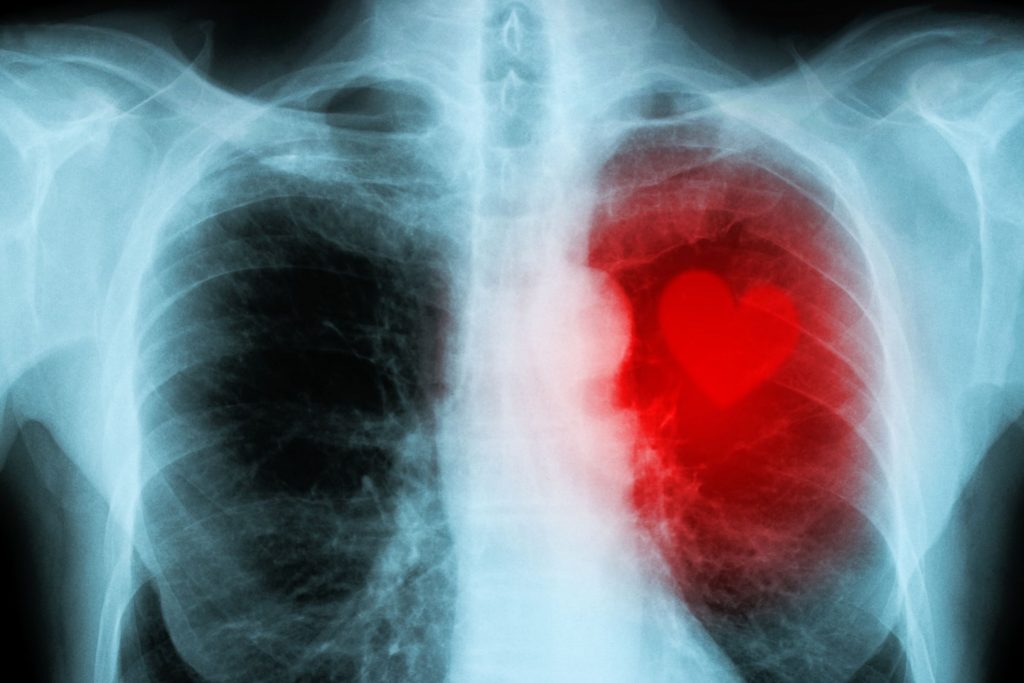 x-ray of chest with heart having red die and actual heart photo to show cardiac ct calcium scoring heart scat heart ct scan