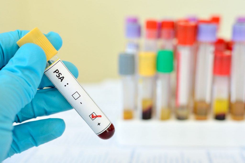 blood vial with psa lab prostate specific antigen lab written on label for prostate screening blood test