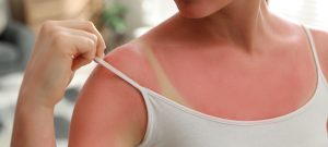 woman with sunburned shoulder