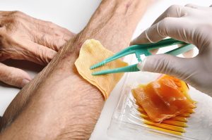 Wound Care Expert Applies Advanced Biologic Dressing to Patient Arm