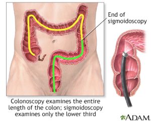 diagram of colonoscopy colonoscope