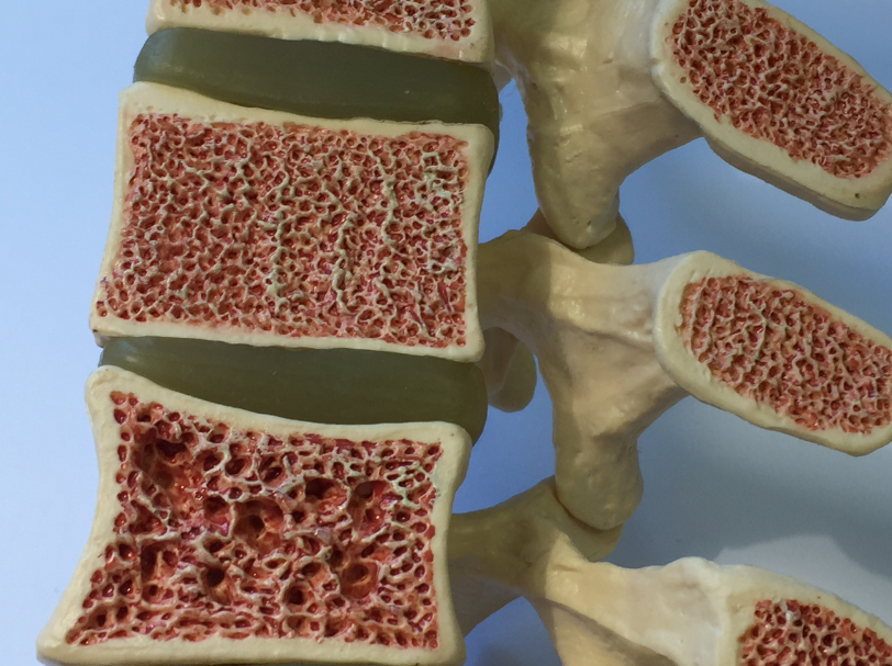 an illustration of bone density of osteoporosis patient