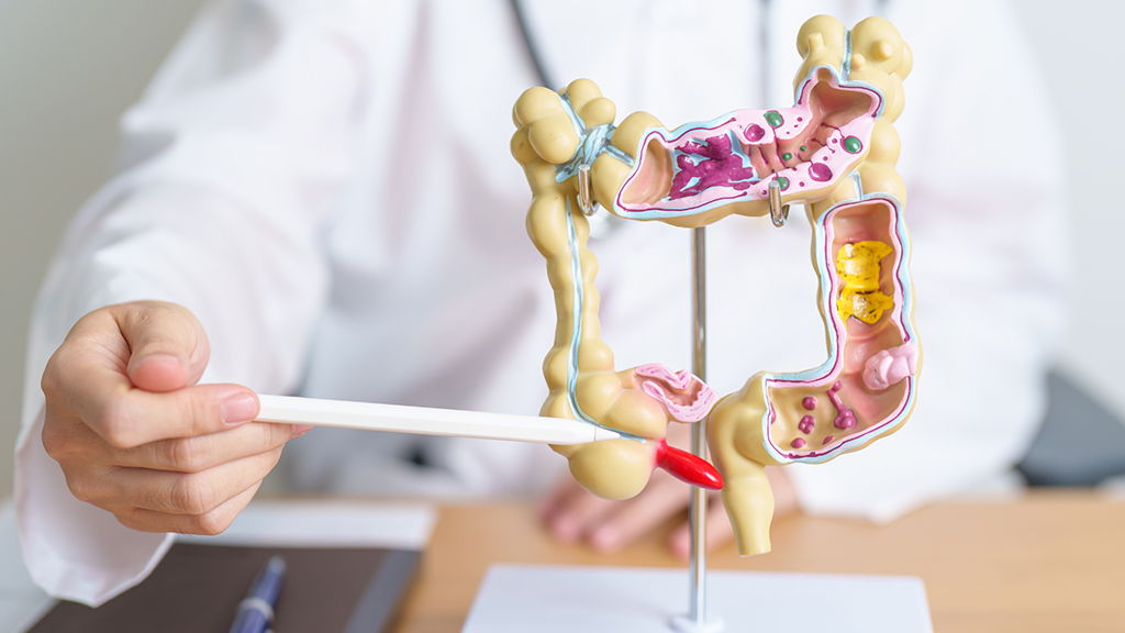 doctor pointing to part of a model of the colon