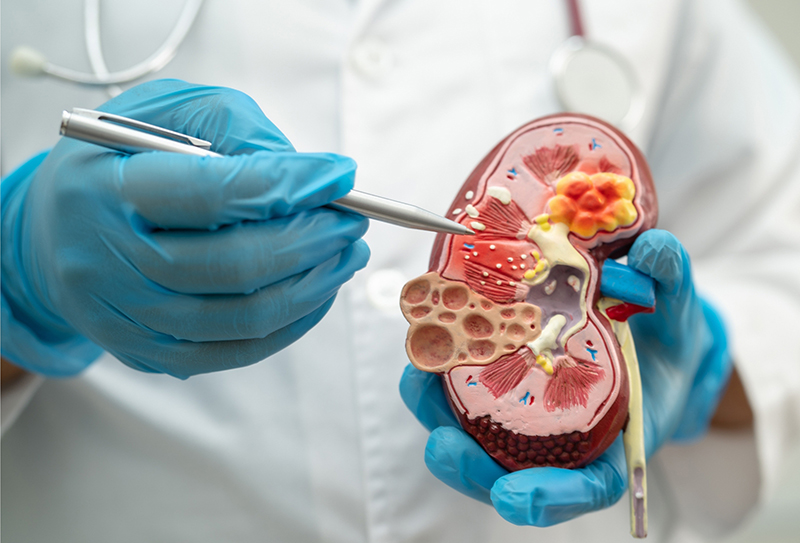 doctor uses a model to explain kidney stones