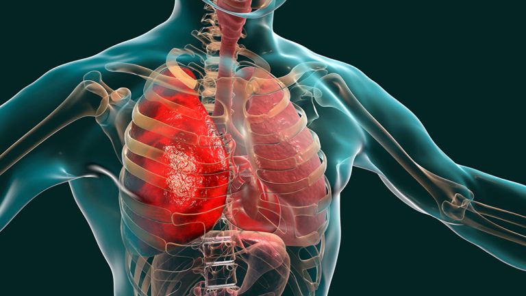 illustration of an x-ray view of the heart and lungs that are examined by pulmonology and referred to pulmonary rehab
