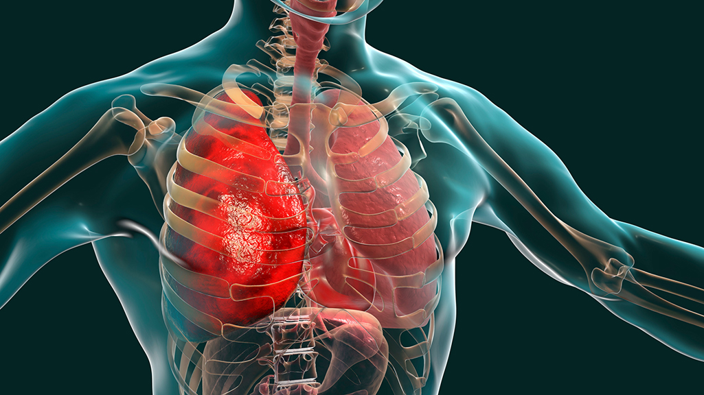illustration of an x-ray view of the heart and lungs that are examined by pulmonology and referred to pulmonary rehab